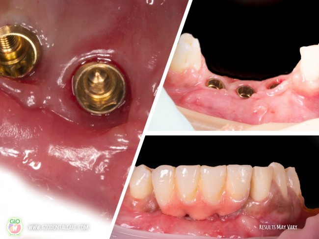 gio-ceramic-crown-bridge-and-implant